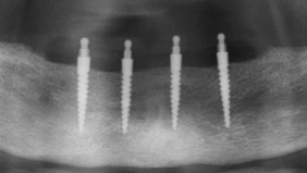 Mini dental implants