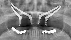 Zygomatic Dental Implants