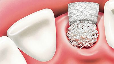 Bone Graft alternative treatment