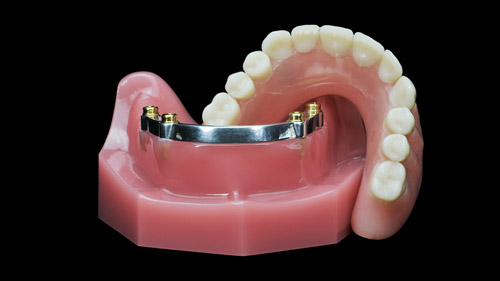 Snap on Denture