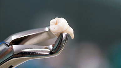 Dental Extraction alternative