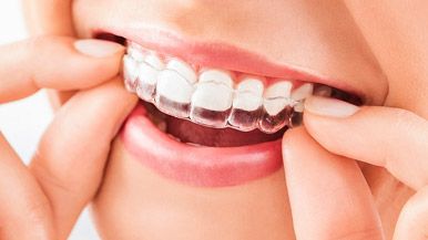 Invisalign Clear Aligners Alternative