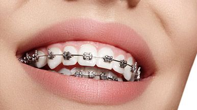 Regular Braces Alterative