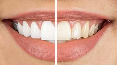 teeth whitening treatment alternative