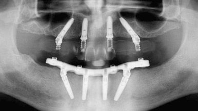 All on four alternative