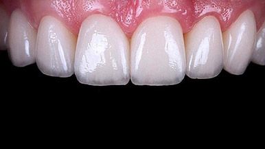 composite resin veneers alternative