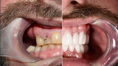 full mouth reconstruction alternative