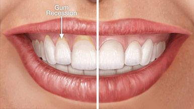 Gum recontouring alternative
