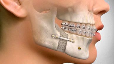 Orthognatic Suegery Alternative