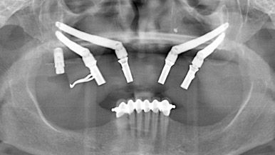 Zygomatic Implants alternative