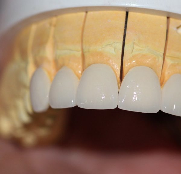 How to prepare dental veneers in mexico during covid-19