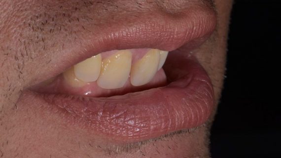 Dental Crowns