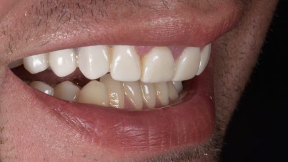 Dental Crowns