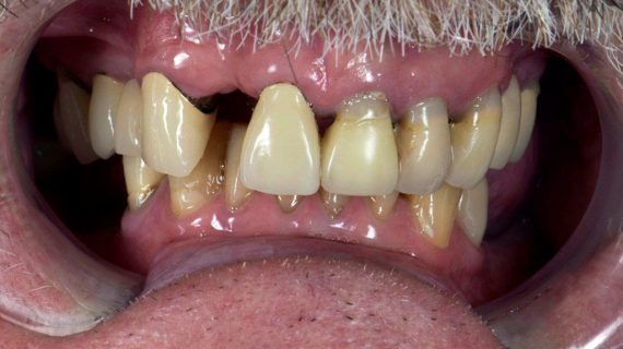 Dental Crowns