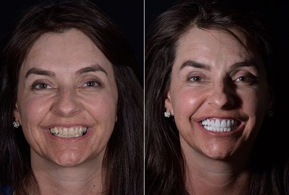 Dental Crowns