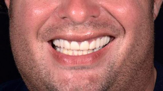 Dental Crowns