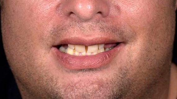 Dental Crowns