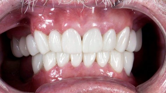 Dental Crowns