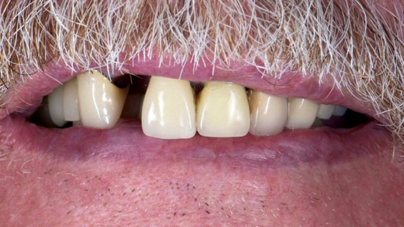 Dental Crowns