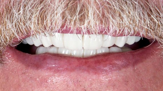 Dental Crowns