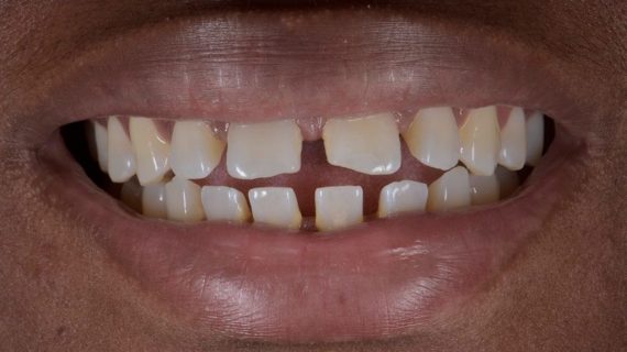 Dental Veneers
