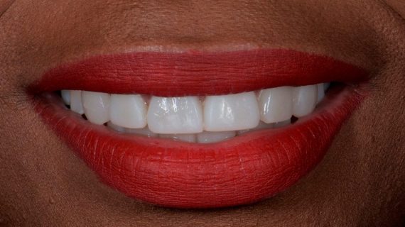 Dental Veneers