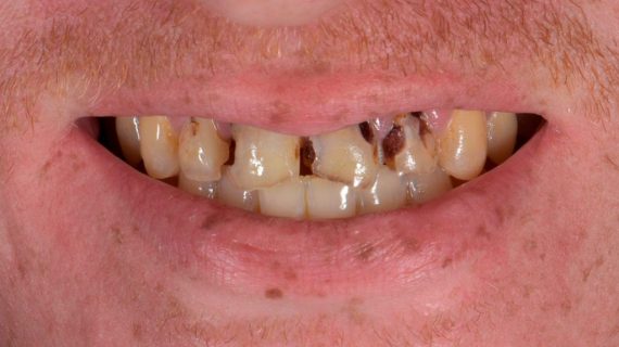 Full Mouth Reconstruction