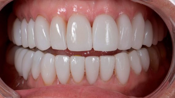 Full Mouth Restoration