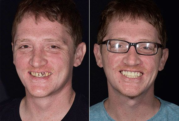 Full Mouth Restoration