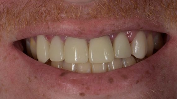 Full Mouth Restoration