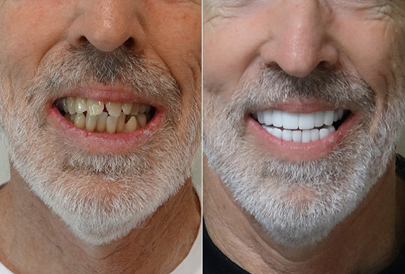 Full Mouth Restoration