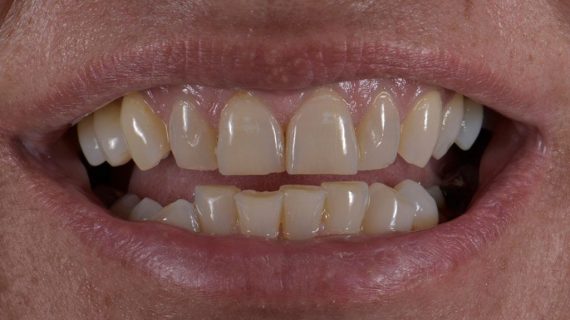 Smile Makeover