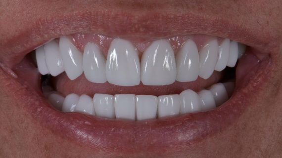 Smile Makeover