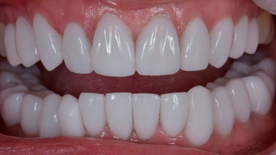 Smile Makeover