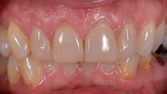 Smile Makeover