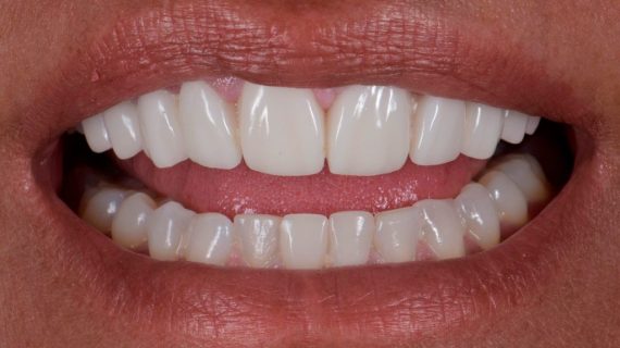 Dental Veneers