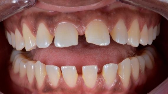 Dental Veneers