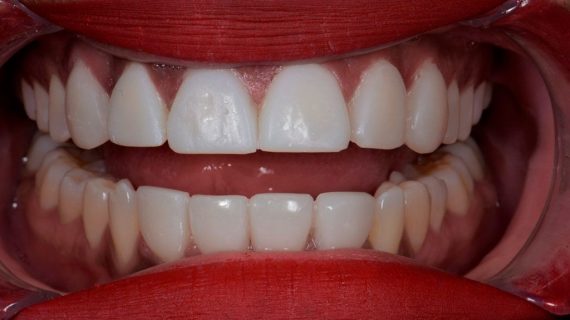 Dental Veneers