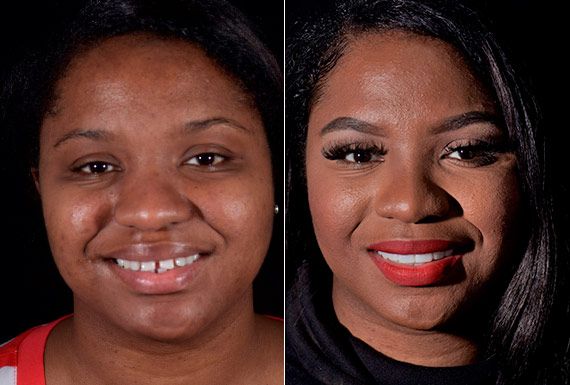 Dental Veneers