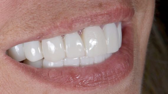 Dental Veneers