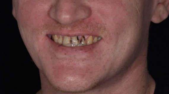 Full Mouth Restoration