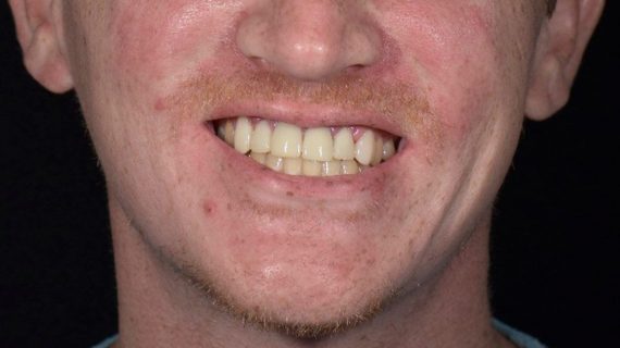 Full Mouth Restoration