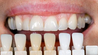 Composite Resin Veneers