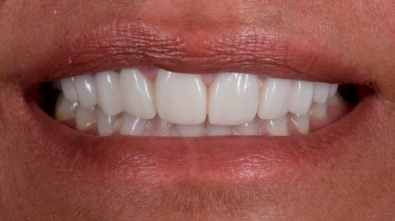 Dental Veneers