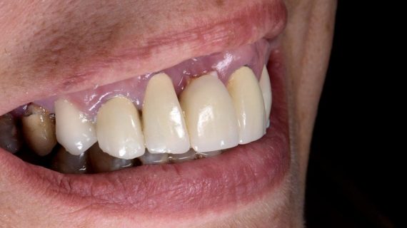 Dental Veneers