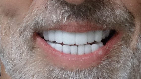 Full Mouth Restoration