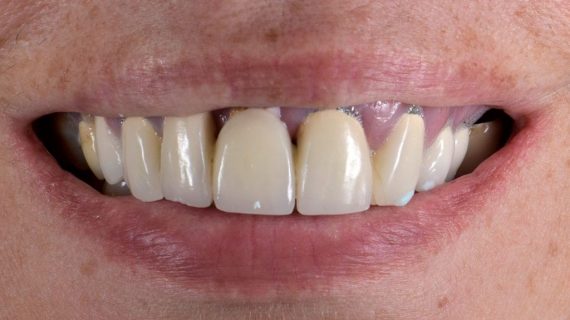 Full Mouth Restoration