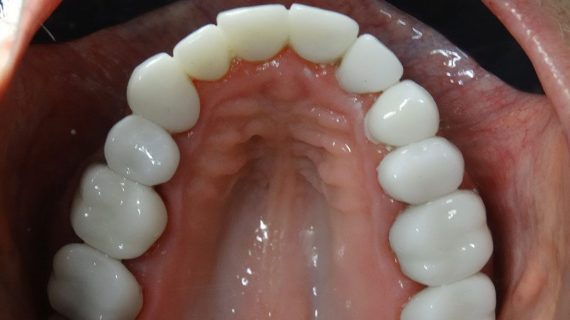 Full Mouth Restoration