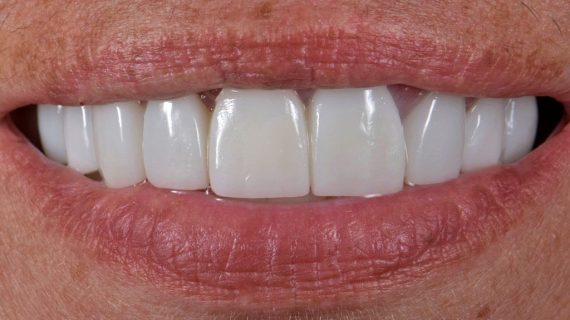 Full Mouth Restoration