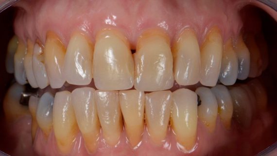 Full Mouth Restoration
